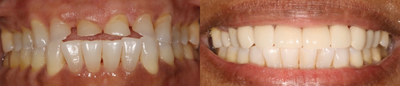 45-54 year old woman treated with Dental Crown - Full upper arch crowns