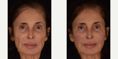 Revanesse Versa- Newest HA Filler - This patient was very concerned with her facial volume loss and was seeking the perfect treatment in order to restore her depleted volume. Revanesse Versa, the newest hyaluronic acid dermal filler to come to the market, was used in combination with Platelet Rich Fibrin (PRF) in order to give our patient her glowing results. Versa is an FDA approved filler for cosmetic treatment of facial wrinkles and creases for facial aesthetic enhancement. This patient received treatment for her under eyes hollows, cheeks, smile lines, and lower third. Results shown are immediately after her procedure and as an extra added benefit, the microcannula technique was used and as a result the patient shows no signs of bruising. Results highlight under eye hollow correction, midfacial volume enhancement, softer looking smile lines, and a fuller appearance to the lower 1/3 of the face (region known as buccal hollows).