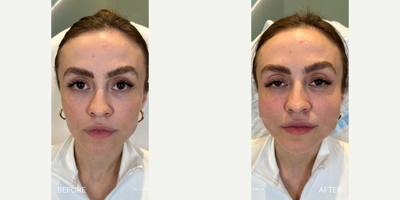 25-34 year old woman treated with Miracu, Thread Lift - Our patient recently became a mom and the lack of sleep and stress of a newborn, left her looking tired and droopy. She's here to have her face rejuvenated by our miraculous Miracu PDO Threads. These incredible threads yield the strongest hold, so they're more than up to the task of this makeover. Our patient already looks very youthful, so this is all about accentuating her existing beauty to get a natural result.