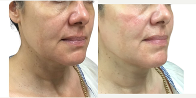 45-54 year old woman treated with Aquagold, Facial - REVIVIFY TREATMENT USING AQUAGOLD FINE TOUCH
