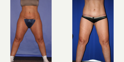 45-54 year old woman treated with Thigh Lift - Lateral thigh lift with vaser liposculpture