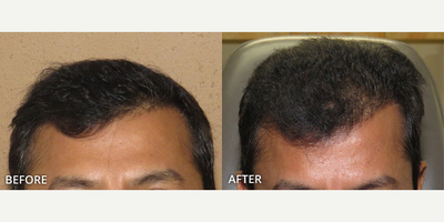 Man treated with Hair Transplant, ARTAS Robotic Hair Transplant - Man treated with Hair Transplant, ARTAS Robotic Hair Transplant
