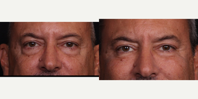 55-64 year old man treated with Eyelid Surgery, Facial Fat Transfer - Lower blepharoplasty with fat grafting B&A.