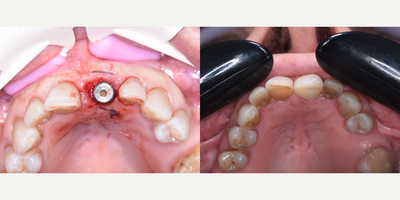 55-64 year old woman treated with Dental Implants, Dental Bone Graft, Dental Crown - 61 years old female patient had an infected upper central incisor tooth which needed to be extracted. 3-D CT plan has indicated the bone is good enough for an implant treatment.Tooth has been extracted carefully to preserve bone and soft tissues. An implant has been placed according to 3D plan. Bone graft has been placed into the gap between implant and extraction socket.Immediate loading temporary was delivered at the day of surgery. This helped us to preserve the shape of gingiva which is very important for pink esthetic in anterior single implant cases. This temporary proshtesis was adjusted to avoid contact with opposing tooth which offered a reasonable aesthetic.In the end of 3 months of healing period, E-max crown over custom zirconia abutment has been delivered to achieve a perfect esthetic result.The result was nice.