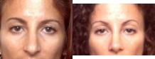 Rhinoplasty - 	Before and after rhinoplasty