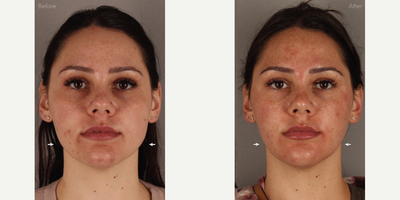 27 year-old Female - Neurotoxin for Jawline Slimming and TMJ Symptom Reduction - Xeomin was used in the masseter (chewing) muscles to eliminate headaches and other symptoms related to TMJ disorder, but also to reduce the size of the masseter muscles and narrow the jaw. This leads to a more aesthetic, heart-shaped face.