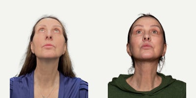 55-64 year old woman treated with Facelift, Neck Lift, Eyelid Surgery, Facial Fat Transfer, Lip Lift - Lesley is 57 years old and traveled from the UK with a clear goal: to look fresher and more rested  while still looking like herself.For the upper face, I performed an endoscopic forehead lift together with an upper blepharoplasty and a temporal lift to restore a softer brow position and create a more open, refreshed eye contour. A cantopexy was also added for additional eyelid support.For the lower eyelids, I performed a lower blepharoplasty to smooth the transition between the eyelid and cheek area.To improve overall facial harmony, I performed fat grafting to selected areas to restore natural volume and support softer contours.For the face and neck, the main structural correction included an extended deep plane facelift combined with a neck lift, helping redefine the jawline and create a more elegant neck profile.For the perioral area, a lip lift was performed to restore a more youthful lip shape and balance.This comprehensive approach allowed us to achieve a result that looks natural, balanced, and refreshed  while keeping Lesley unmistakably herself.
