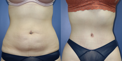 25-34 year old transgender woman treated with a Tummy Tuck - MTF abdominoplasty