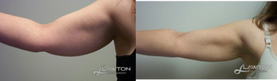 35-44 year old woman treated with Liposculpture - 35-44 year old woman treated with Liposculpture
