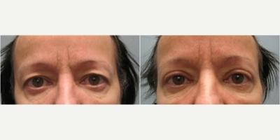 55-64 year old woman treated with Upper Eyelid Surgery - 57 year old woman treated with Upper Eyelid Surgery