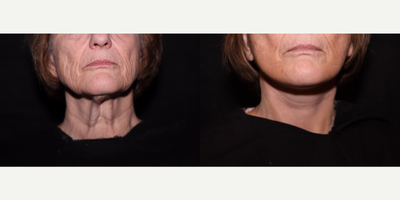 Laser Fractional Resurfacing - Laser Fractional Resurfacing