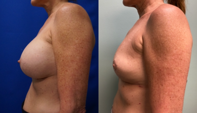 45-54 year old woman treated with Breast Implant Removal and Lollipop (vertical pattern) Breast Lift - This patient presented with 400 cc smooth saline implants that were placed underneath the muscle. She underwent breast implant removal (explant) with total capsulectomy and a lollipop (vertical pattern) breast lift. Note that there is no scarring in the breast fold.