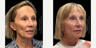 65-74 year old woman treated with CoolPeel, Morpheus8 Microneedling RF & Sculptra - This 65+ year old patient wanted facial rejuvenation without surgery. She had Morpheus8 RF microneedling to firm and smooth her skin, CO CoolPeel Laser treatment to brighten her complexion and soften fine lines, and Sculptra injections to restore midface volume. Her results show lifted cheeks, smoother texture, and a refreshed, more youthful appearance.