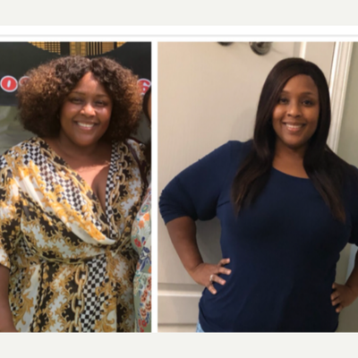 Gastric Bypass before and after photo