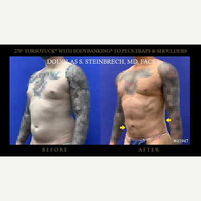 Body Lift before and after photo