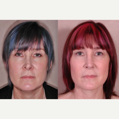 Revision Rhinoplasty before and after photo