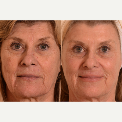 Halo Laser before and after photo