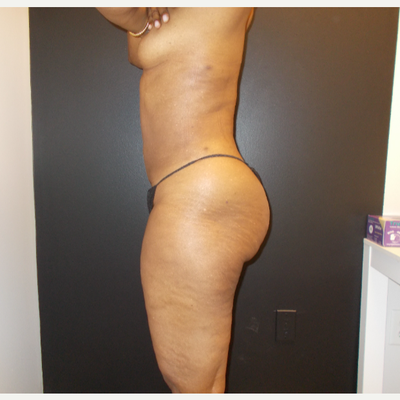 Asymmetrical Breasts - Atlanta Liposuction Specialty Clinic