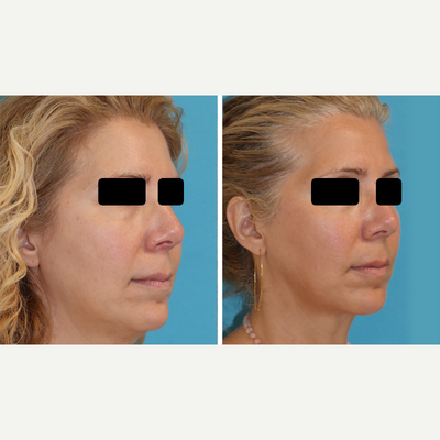 Can You Contour Your Jawline Without Surgery? - Eugenie Brunner, M.D.,  F.A.C.S