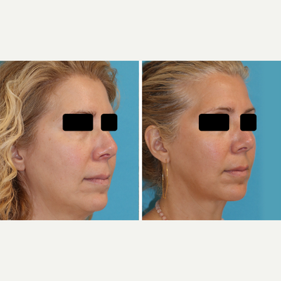 Smart Lipo before and after photo