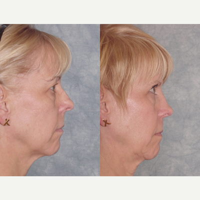 Rhinoplasty before and after photo