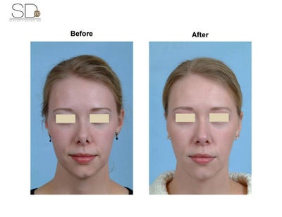 Revision Rhinoplasty before and after photo