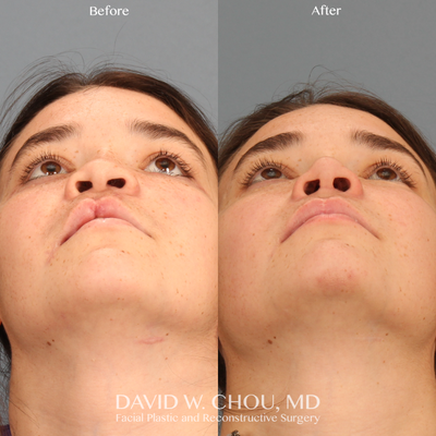 Rhinoplasty before and after photo