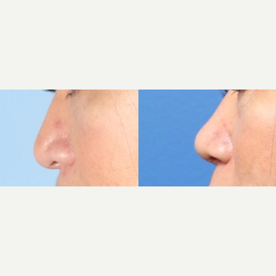Asian Rhinoplasty before and after photo