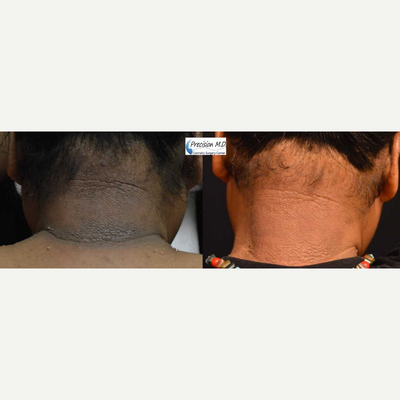 Laser Resurfacing before and after photo