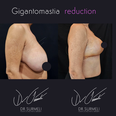 Breast Reduction before and after photo