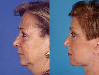 Facelift before and after photo