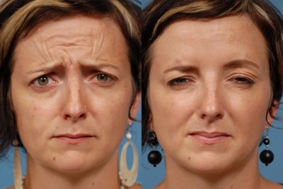 Dysport before and after photo