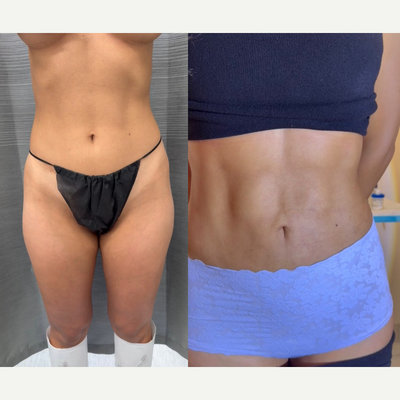 Liposuction before and after photo