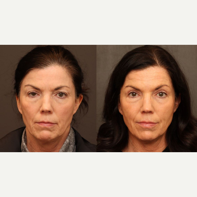 Eyelid Surgery before and after photo
