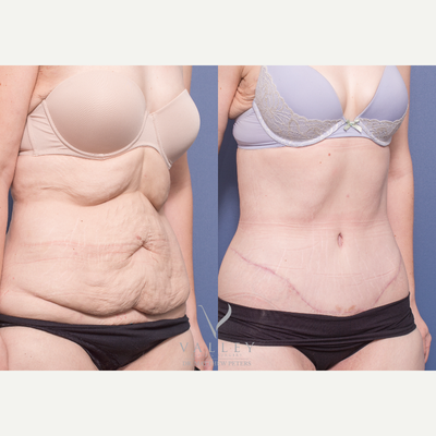 Body Lift before and after photo