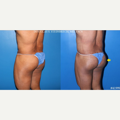 Butt Implants before and after photo