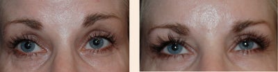 Latisse before and after photo