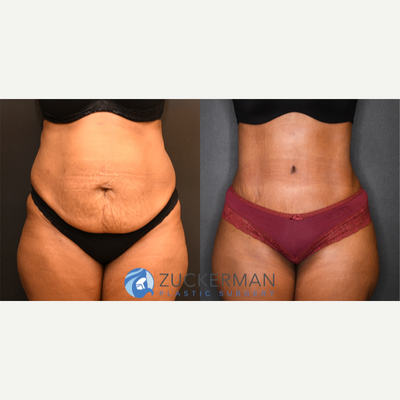 Tummy Tuck before and after photo
