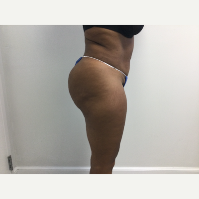 Brazilian Butt Lift (BBL) Recovery Tagged Stage 2 - Snatched body