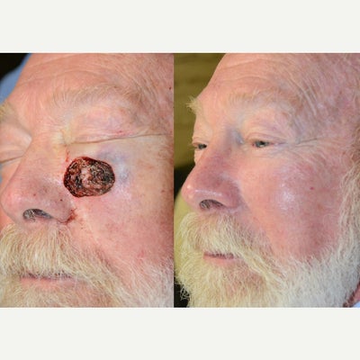 Facial Reconstructive Surgery before and after photo