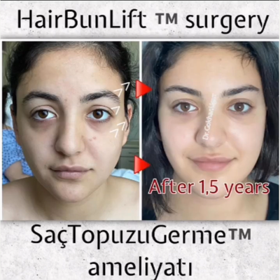 Canthoplasty before and after photo