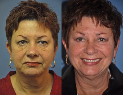 Eyelid Surgery before and after photo