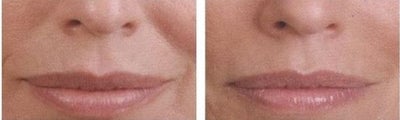 Juvederm before and after photo