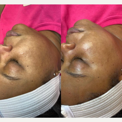 Dermaplaning before and after photo