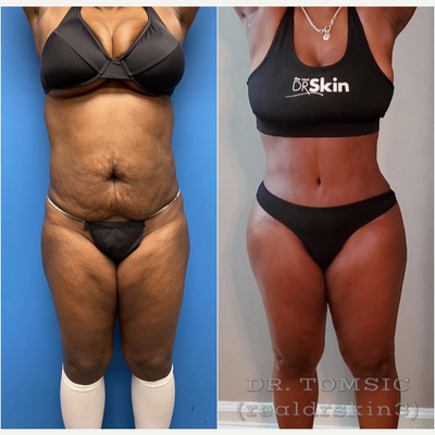 Skin Tightening before and after photo