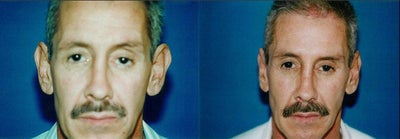 Ear Surgery before and after photo
