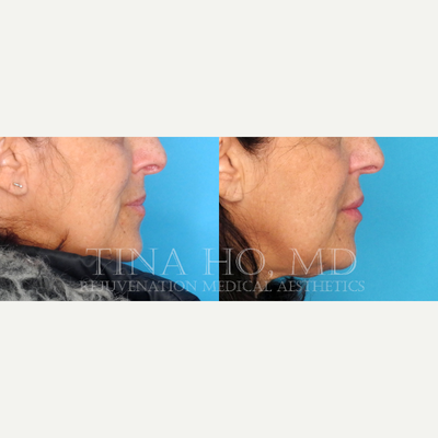 Lip Fillers before and after photo