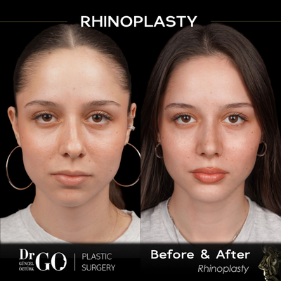 Chin Implant before and after photo