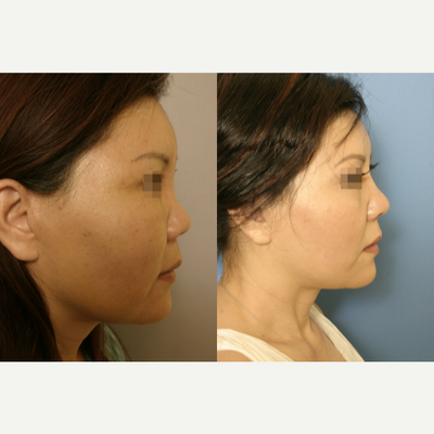 Rhinoplasty before and after photo
