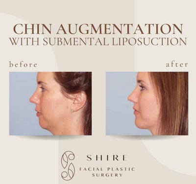 Chin Liposuction before and after photo